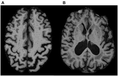 Enlarged Perivascular Spaces Are Negatively Associated With Montreal Cognitive Assessment Scores in Older Adults